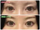 蒙古ひだ形成 R.O.clinic BEFORE サムネイル用