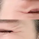 シワ取りボトックス 湘南美容クリニック 藤沢院 BEFORE サムネイル用