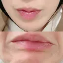 シワ取りボトックス 湘南美容クリニック 藤沢院 BEFORE サムネイル用