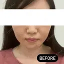 糸リフト / ヒアルロン酸注入（頬） EMMA CLINIC（エマクリニック） BEFORE サムネイル用