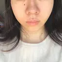 エレクトロポレーション / 毛穴洗浄（ハイドラフェイシャルなど） AURORA CLINIC（オーロラクリニック）新宿院 BEFORE サムネイル用