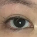 目頭切開 / 目尻切開 / 目尻靭帯移動 FROM B整形外科 (旧バウム整形外科) BEFORE サムネイル用