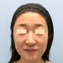 額を丸く / 脂肪注入（額） / 脂肪注入（輪郭） eクリニック 金沢本院 BEFORE サムネイル用