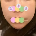 糸リフト / 脂肪溶解注射（顔） 東京ロイヤルクリニック BEFORE サムネイル用