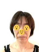 プラセンタ注射 / ハイフ（顔） 心斎橋藤井クリニック BEFORE サムネイル用