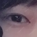 二重切開 / 上まぶたの脂肪取り 松下皮フ形成外科 BEFORE サムネイル用