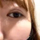 二重埋没 AiZ CLINIC BEFORE サムネイル用