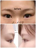 二重切開 / 上まぶたの脂肪取り 樹のひかり 形成外科・皮ふ科 BEFORE サムネイル用