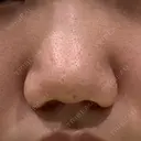 小鼻縮小（切開） / 鼻翼挙上 / 鼻孔縁挙上 くさのたろうクリニック BEFORE サムネイル用