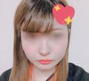 バッカルファット除去 / 脂肪吸引（顔） / ボトックス（あご） / ヒアルロン酸注入（あご） / ボトックス（エラ・小顔） / ヒアルロン酸注入（唇） / ボトックス（口角） エートップ美容整形外科 BEFORE サムネイル用