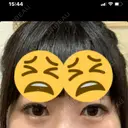二重埋没 TCB東京中央美容外科 心斎橋筋院 BEFORE サムネイル用