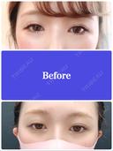 二重埋没 湘南美容クリニック 渋谷院 BEFORE サムネイル用
