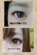 二重埋没 品川美容外科 福岡院 BEFORE サムネイル用