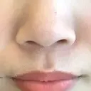 鼻尖形成（切開） / ヒアルロン酸注入（鼻） / ヒアルロン酸注入（あご） 東京ヒルズクリニック 新宿院 BEFORE サムネイル用