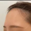 額を丸く / ヒアルロン酸注入（額） 藤・ナチュレ美容クリニック 恵比寿院 BEFORE サムネイル用