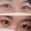 目頭切開 目白ポセンシアクリニック BEFORE サムネイル用