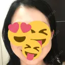 脂肪注入（額） 牧野美容クリニック BEFORE サムネイル用