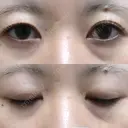 クマ治療 / 下まぶたの脂肪取り 湘南美容クリニック 赤羽院 BEFORE サムネイル用
