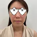 ハイフ（顔） 藤・ナチュレ美容クリニック 恵比寿院 BEFORE サムネイル用