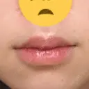 口唇縮小術 B-LINE CLINIC 池袋院 BEFORE サムネイル用