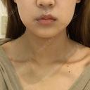 脂肪溶解注射（顔） 有楽町美容外科クリニック BEFORE サムネイル用
