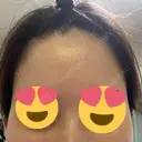脂肪注入（額） / 脂肪注入（輪郭） 牧野美容クリニック BEFORE サムネイル用