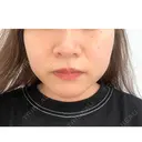 バッカルファット除去 / 脂肪吸引（顔） EMMA CLINIC（エマクリニック） BEFORE サムネイル用