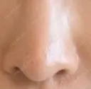 フラクショナルレーザー（毛穴・ニキビ跡） PICO BEAUTY CLINIC BEFORE サムネイル用