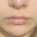 ヒアルロン酸注入（唇） / ボトックス（口角） / ボトックス（肩） ルラ美容クリニック 新宿院 BEFORE サムネイル用