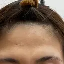 ボトックス（額） / 再生医療 クリニックビューティー恵比寿 BEFORE サムネイル用