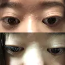 二重切開 / その他（目元） / 上まぶたたるみ取り 新前橋かしま眼科形成外科クリニック BEFORE サムネイル用