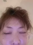 二重埋没 / その他（目元） / 糸リフト / 脂肪吸引（顔） / その他（ボディ） / ジョールファット除去 / ボトックス（あご） / 脂肪溶解注射（お腹） / その他（口元） WOM CLINIC GINZA （ワム クリニック ギンザ） BEFORE サムネイル用