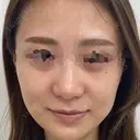 水光注射（ハリ・美肌） 表参道ウィズ・クリニック BEFORE サムネイル用