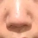 鼻尖形成（切開） / 小鼻縮小（切開） / 軟骨移植 牧野皮膚科医院 BEFORE サムネイル用