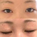 二重切開 / 目頭切開 / 眼瞼下垂（切開） / 脂肪吸引（顔） eクリニック 金沢本院 BEFORE サムネイル用