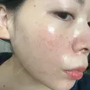 光治療（フォトフェイシャルなど） LETICIA CLINIC（レティシア クリニック） BEFORE サムネイル用