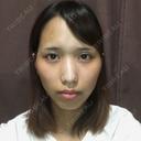 二重埋没 / 骨切り（あご） / 骨削り（頬） / 軟骨移植 / 骨切幅寄せ バノバギ整形外科 BEFORE サムネイル用