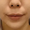 人中短縮 / その他（口元） eクリニック 金沢本院 BEFORE サムネイル用