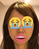 鼻中隔延長（切開） / 軟骨移植 / ワシ鼻修正・ハンプ切除 / ヒアルロン酸注入（鼻） プリモ麻布十番クリニック BEFORE サムネイル用