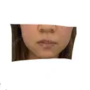 ボトックス（口角） / その他（口元） 表参道スキンクリニック 名古屋院（DAILY SKIN CLINIC提携院） BEFORE サムネイル用