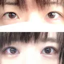 二重切開 / 目元修正 ルネッサンス美容外科医院 神戸院 BEFORE サムネイル用