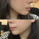 ヒアルロン酸注入（あご） 東京イセアクリニック BEFORE サムネイル用