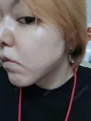 シミ取りレーザー PICO BEAUTY CLINIC BEFORE サムネイル用