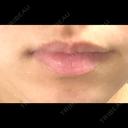 ヒアルロン酸注入（唇） / ボトックス（口角） フィラークリニック 名古屋栄院 BEFORE サムネイル用