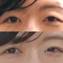 二重切開 城本クリニック 長崎院 BEFORE サムネイル用