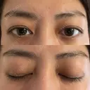 眉下切開 e:Top clinic（イートップクリニック） BEFORE サムネイル用