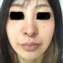 ピコレーザートーニング（美白・肝斑） B-LINE CLINIC 池袋院 BEFORE サムネイル用