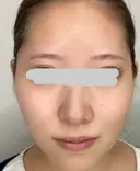 糸リフト / 脂肪吸引（顔） / ジョールファット除去 アリエル美容クリニック 大宮院 BEFORE サムネイル用