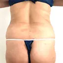 脂肪溶解注射（お腹） 渋谷美容外科クリニック 新宿院 BEFORE サムネイル用