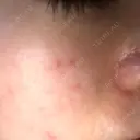 ピーリング（ニキビ・毛穴） / イオン導入 / ピーリング（ハリ・ツヤ） 渋谷美容外科クリニック 新橋院 BEFORE サムネイル用